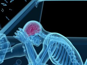 an illustration of a Brain-Injury after a car accident